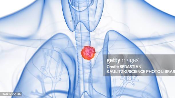 stockillustraties, clipart, cartoons en iconen met oesophagus tumour, illustration - slokdarm