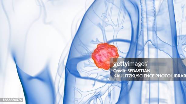 lung tumour, illustration - chronic obstructive pulmonary disease stock illustrations
