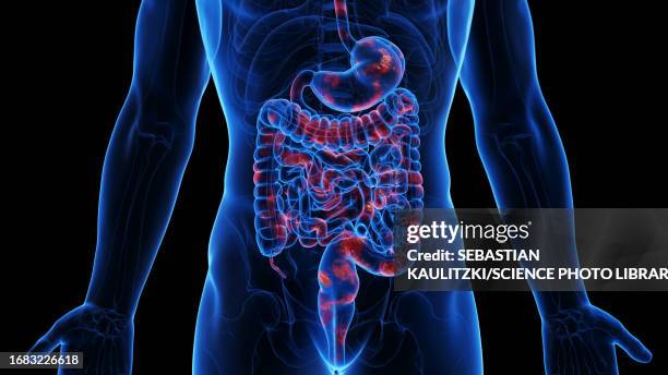 stockillustraties, clipart, cartoons en iconen met crohn's disease, illustration - spijsverteringsstelsel