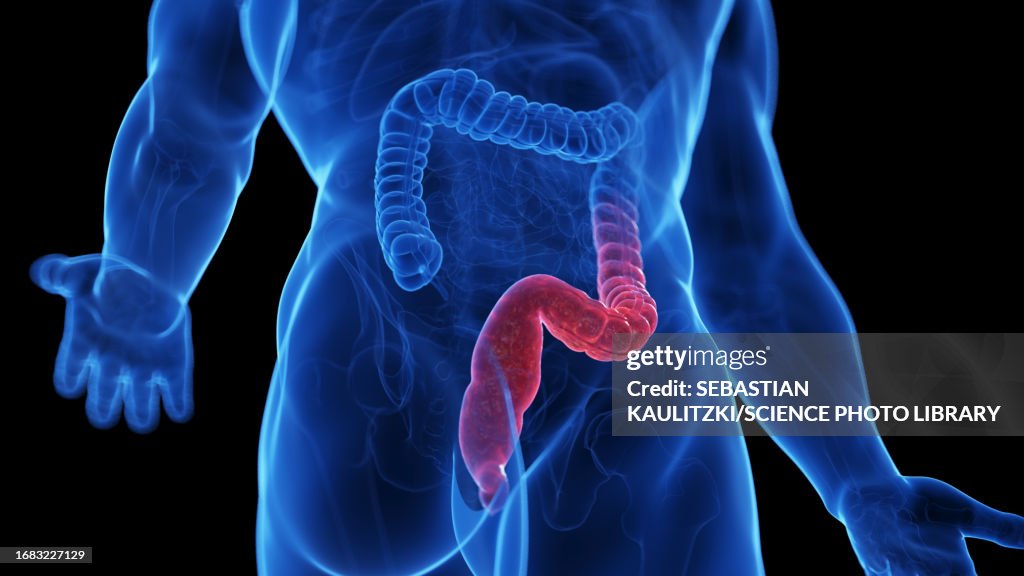 Ulcerative Colitis Gi Ulcerative Colitis Illustration High-Res Vector Graphic - Getty Images