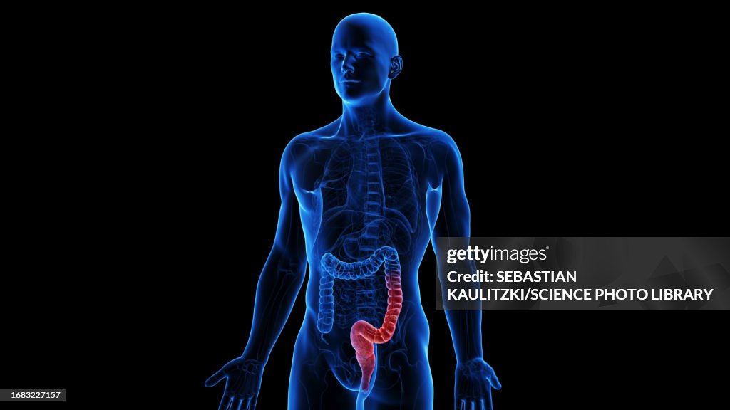 Ulcerative Colitis Gi Ulcerative Colitis Illustration High-Res Vector Graphic - Getty Images