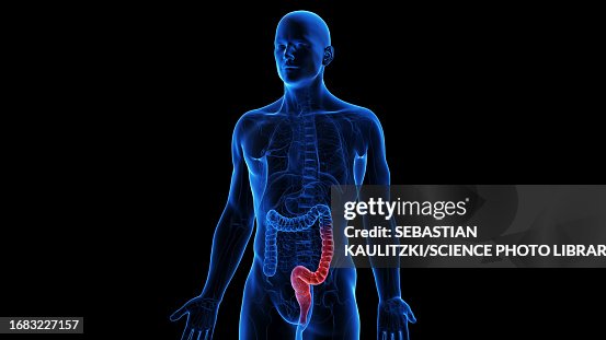Ulcerative Colitis Gi Ulcerative Colitis Illustration High-Res Vector Graphic - Getty Images