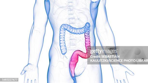 ulcerative colitis, illustration - ulcerative colitis stock illustrations