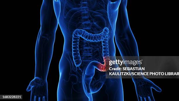 ulcerative colitis, illustration - ulcerative colitis stock illustrations