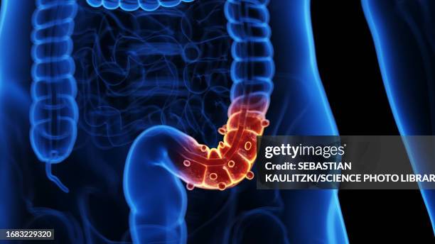 diverticulitis, illustration - diverticulitis stock illustrations