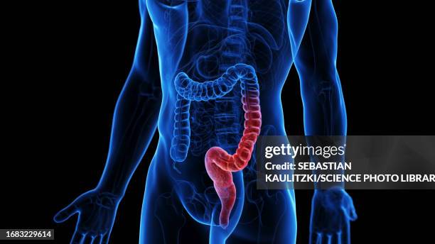 ulcerative colitis, illustration - ulcerative colitis stock illustrations