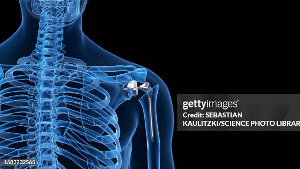 shoulder replacement, illustration - surgical equipment stock illustrations