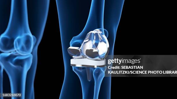 knee replacement, illustration - surgical equipment stock illustrations