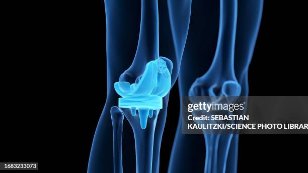 knee replacement, illustration - knee replacement stock illustrations