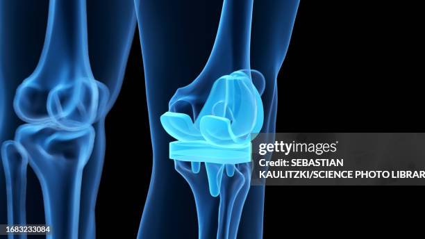 knee replacement, illustration - knee replacement surgery stock illustrations