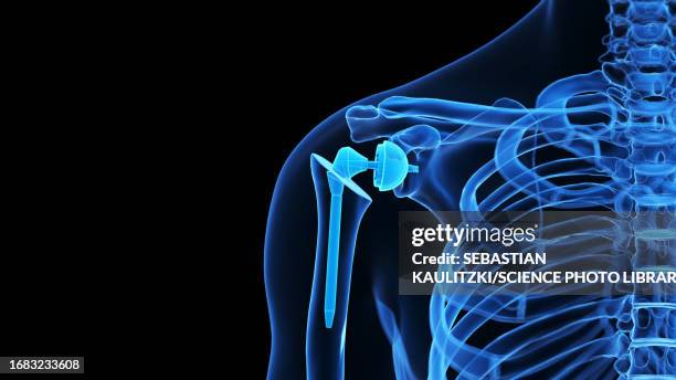 shoulder replacement, illustration - shoulder replacement stock illustrations