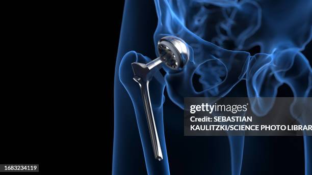 hip replacement, illustration - hip replacement stock illustrations