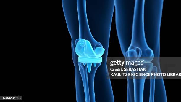 illustrazioni stock, clip art, cartoni animati e icone di tendenza di knee replacement, illustration - knee replacement surgery