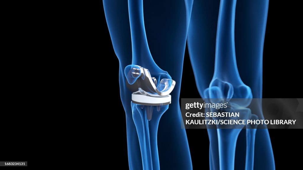 Knee replacement, illustration