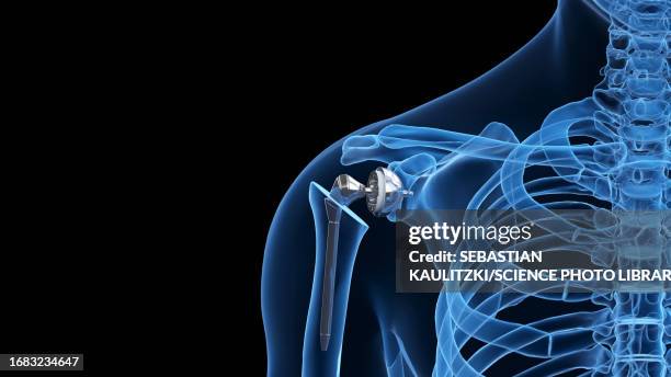 shoulder replacement, illustration - shoulder replacement stock illustrations