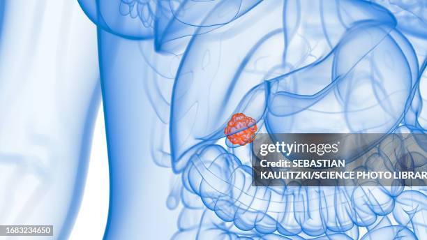 illustrazioni stock, clip art, cartoni animati e icone di tendenza di gallbladder cancer, illustration - bilirubina