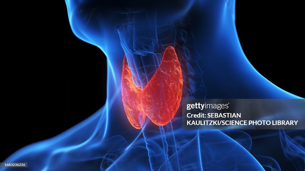 Inflamed thyroid gland, illustration