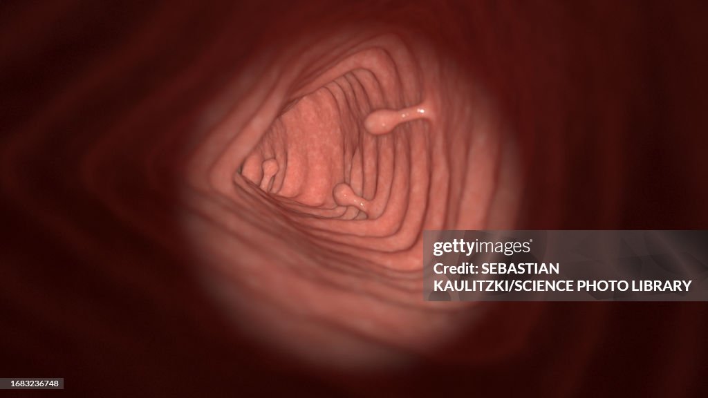 Polyps Colon Polyps Illustration High-Res Vector Graphic - Getty Images