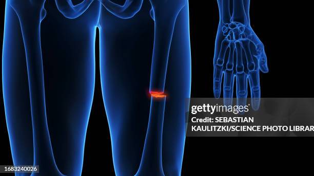 broken leg, illustration - femur stock illustrations
