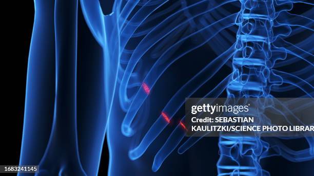 broken ribs, illustration - animal rib cage stock illustrations