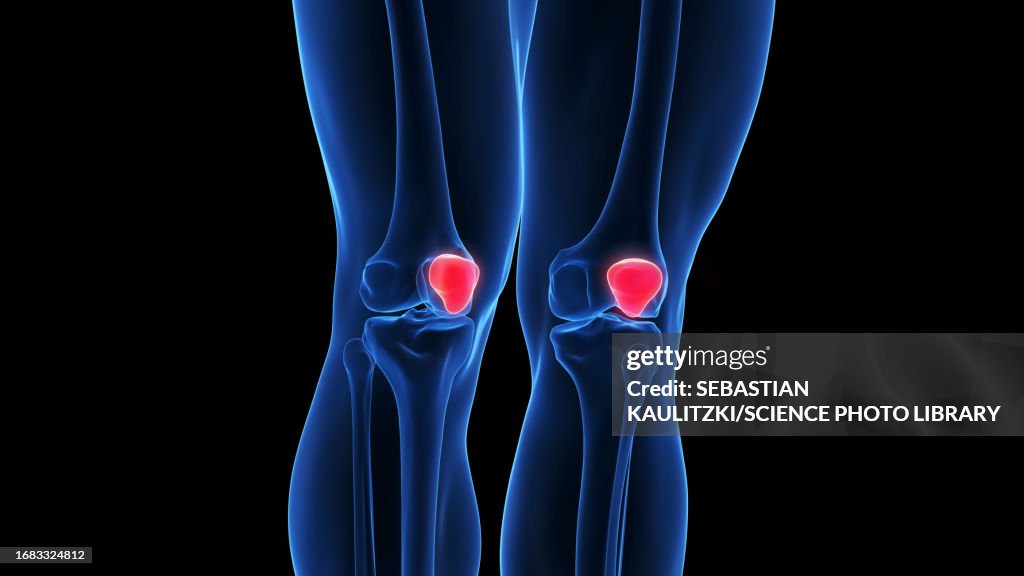 Multilater Patella Patella Illustration High-Res Vector Graphic - Getty Images