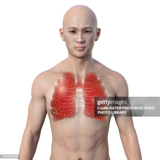 man with miliary tuberculosis, illustration - man difficulty breathing stock illustrations