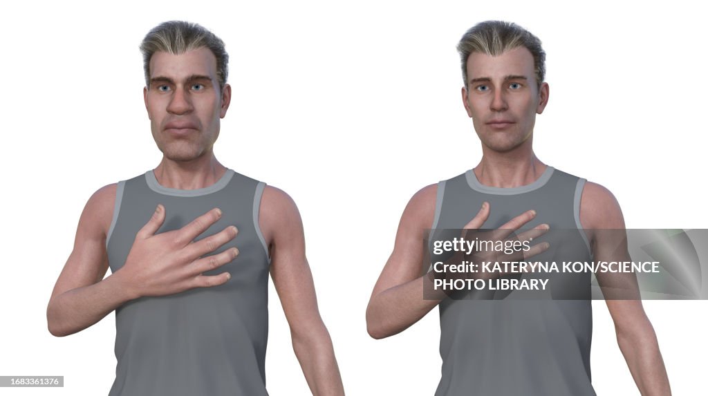 Man with and without acromegaly, illustration