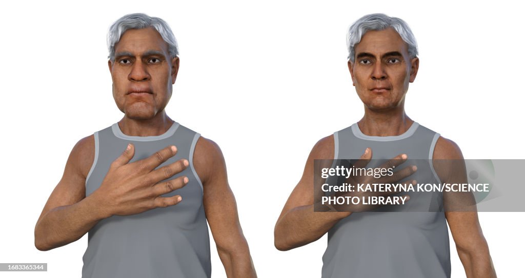 Man with and without acromegaly, illustration