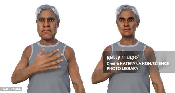 man with and without acromegaly, illustration - deformed hand stock illustrations