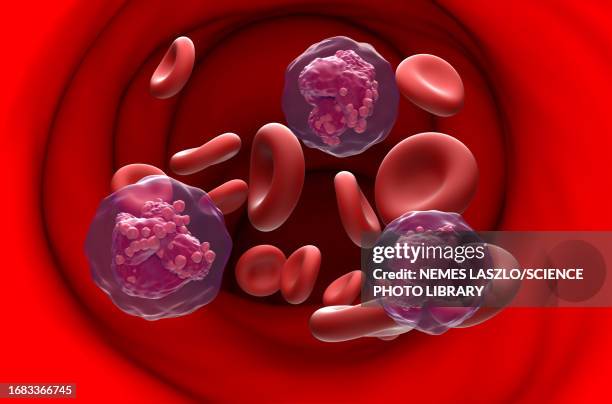 acute lymphoblastic leukemia, illustration - lymphoma 幅插畫檔、美工圖案、卡通及圖標