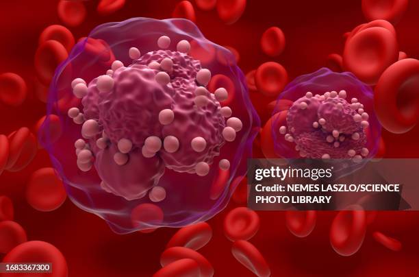 illustrazioni stock, clip art, cartoni animati e icone di tendenza di acute lymphoblastic leukemia, illustration - leucemia