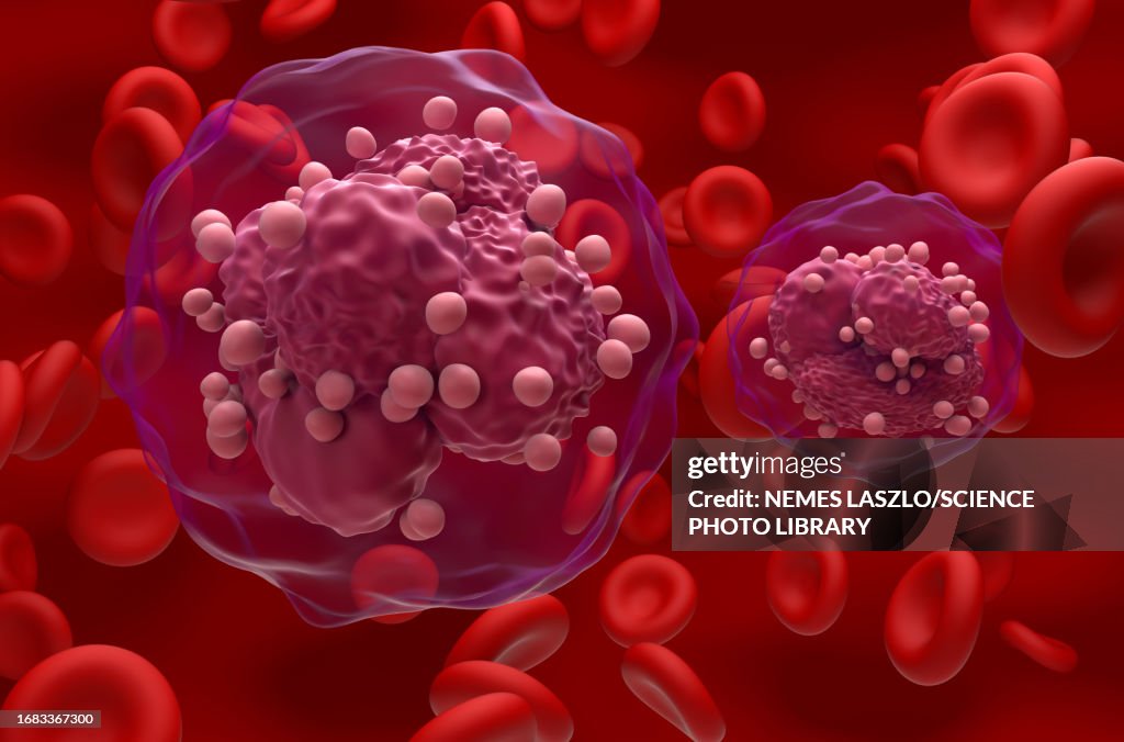 Acute lymphoblastic leukemia, illustration