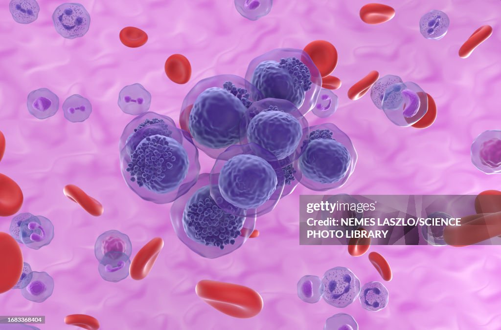 Acute myeloid leukemia, illustration