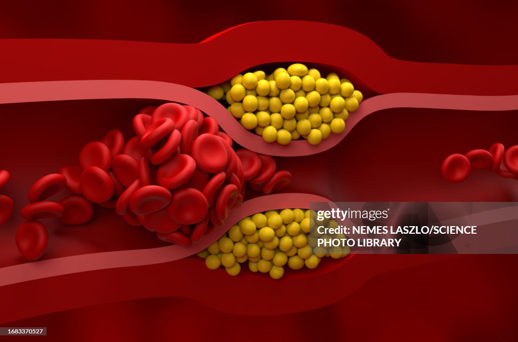 Blocked artery, illustration