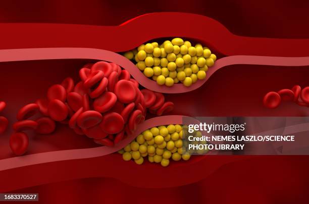 blocked artery, illustration - clogged artery stock illustrations