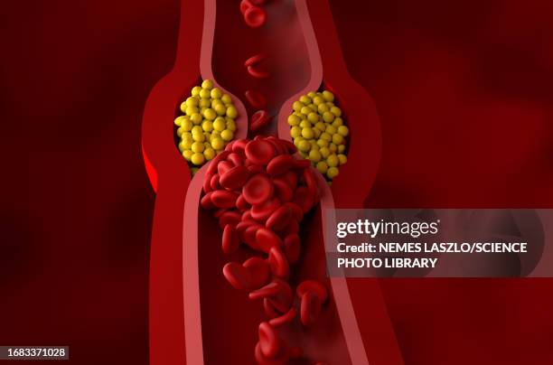 narrowed artery, illustration - clogged artery stock illustrations