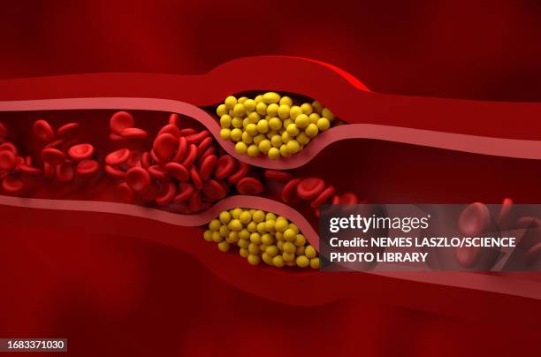 narrowed artery, illustration - clogged artery stock illustrations