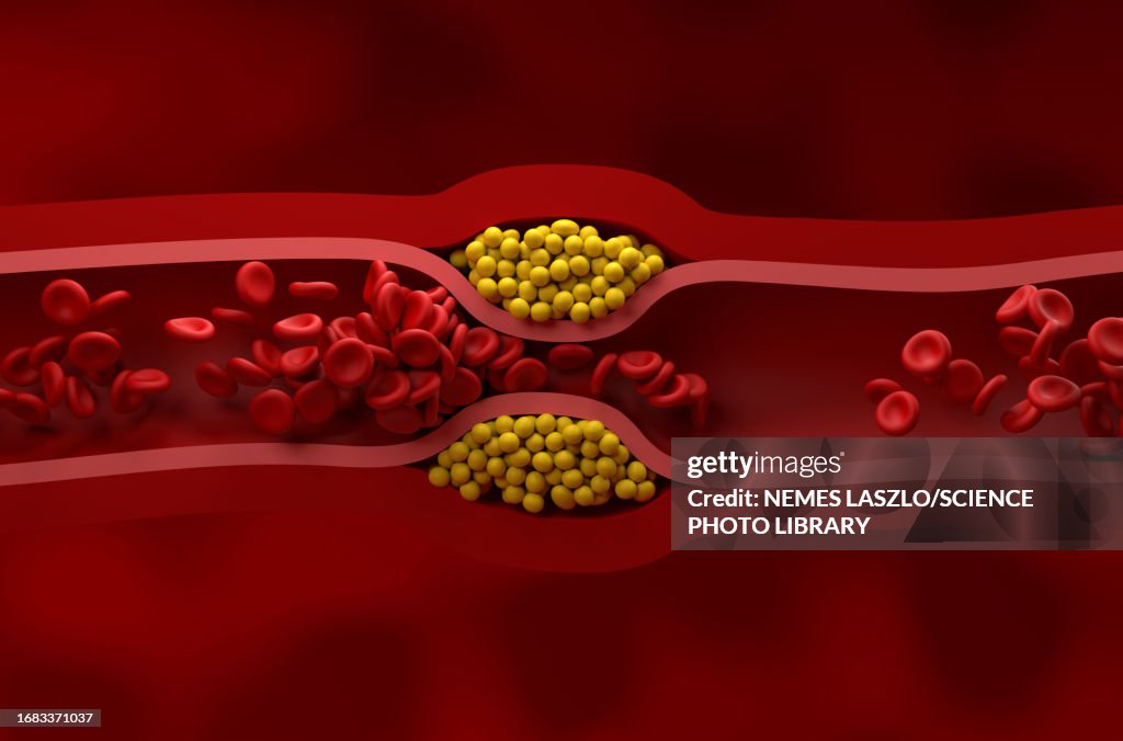 Narrowed artery, illustration