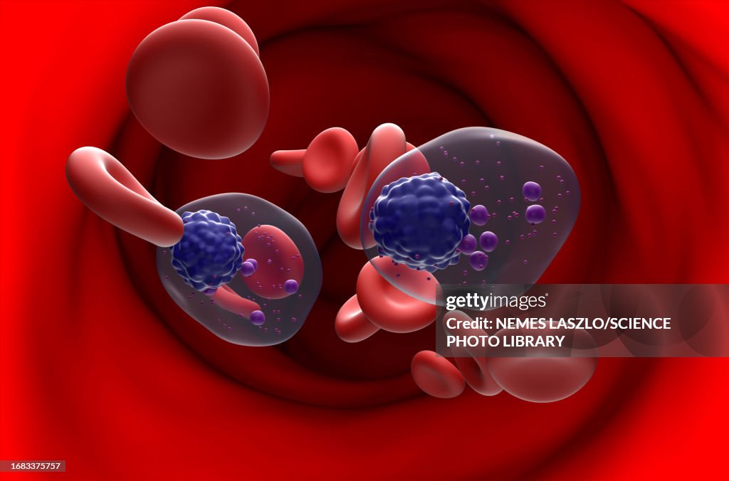 Multiple myeloma, illustration