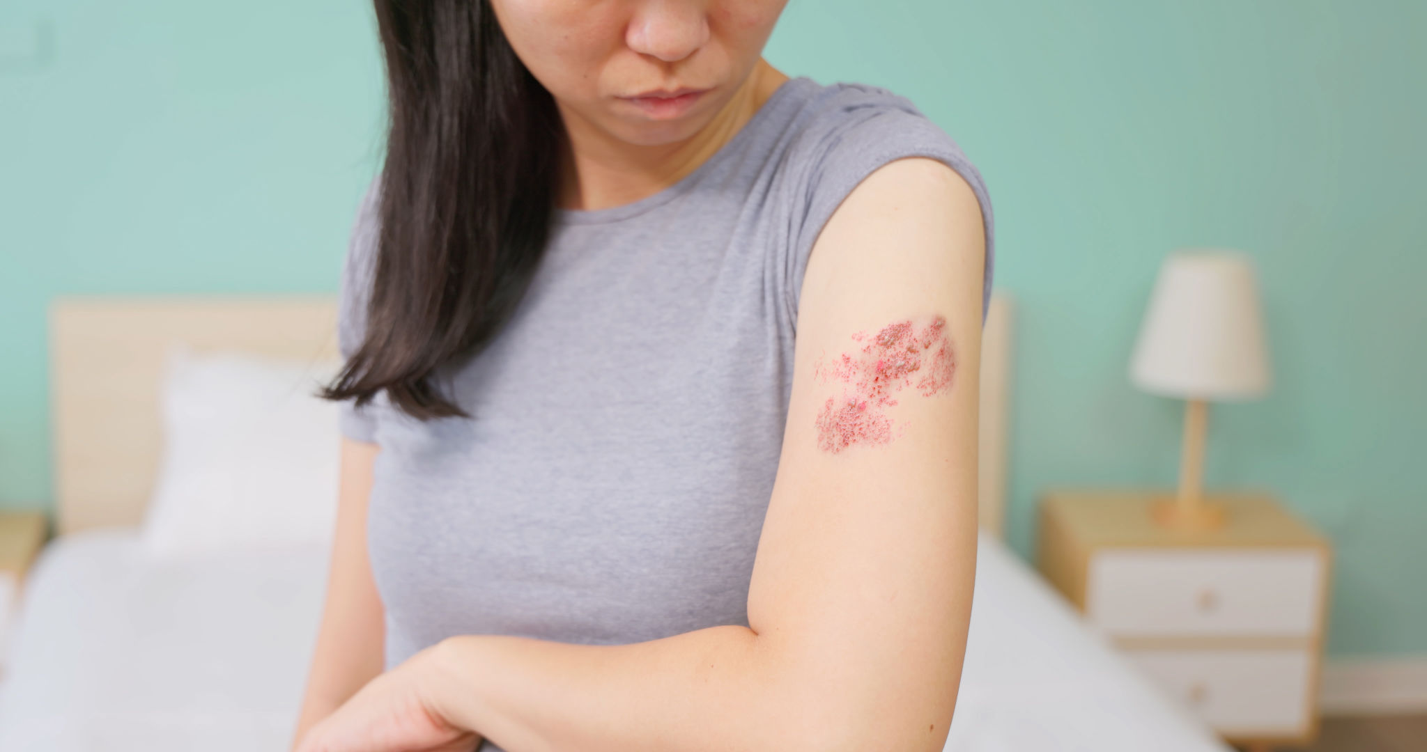 skin rash