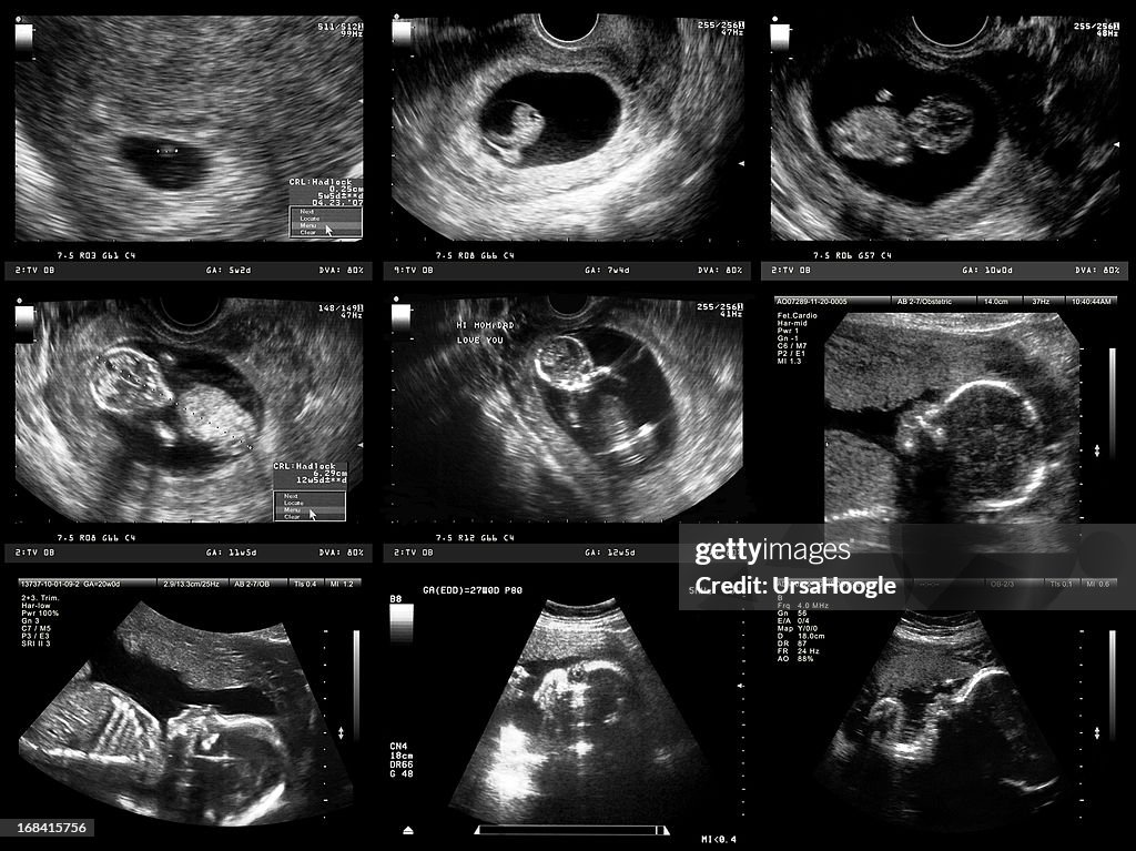 Pregnancy Ultrasound