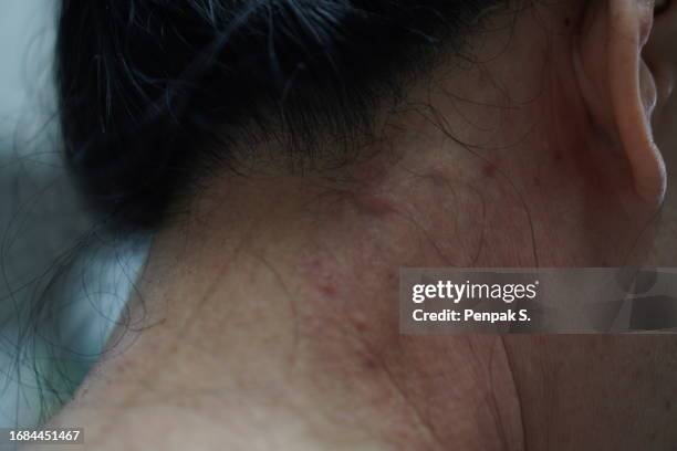 Nappy Rash Neck 571 Neck Nape Of The Neck Stock Photos, High-Res Pictures, and Images ...