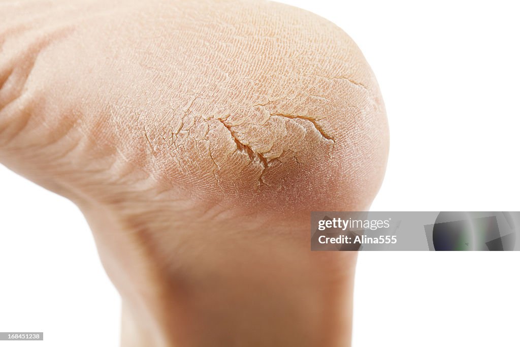 Dry and cracked woman's heel on white background