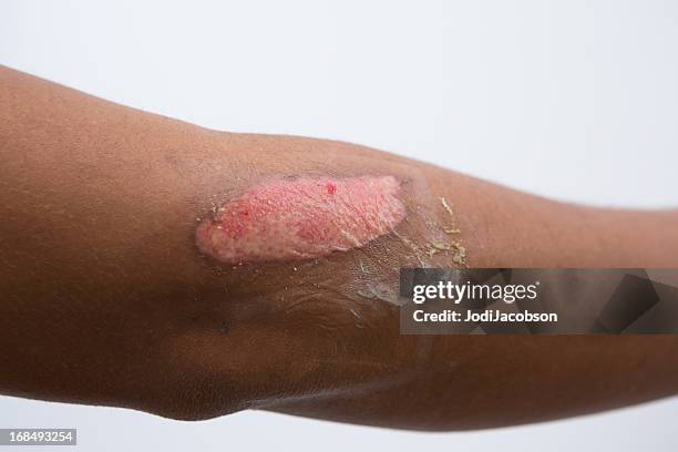 medical: second degree burn - hand laceration stockfoto's en -beelden