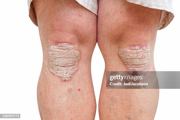 psoriasis en mans las rodillas de mediana edad - psoriasis fotografías e imágenes de stock