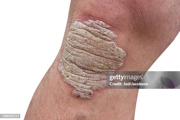 psoriasis on a mid age man's knee - psoriasis stock pictures, royalty-free photos & images