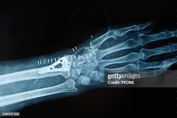 x 線画像の手動骨折 - broken finger ストックフォトと画像