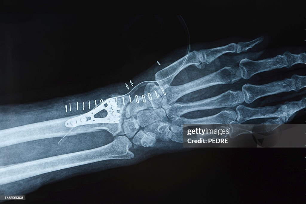 X-ray image hand fracture