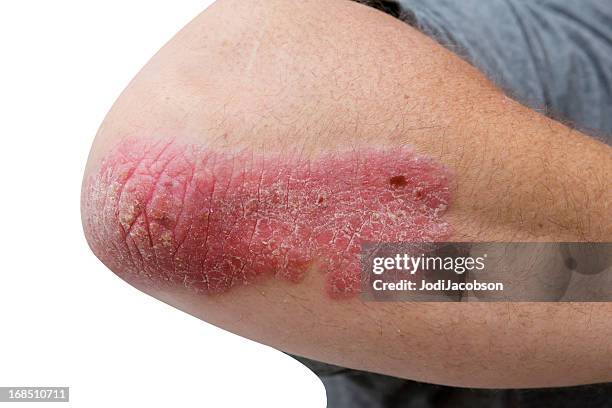 psoriasis en mans codo de mediana edad - psoriasis fotografías e imágenes de stock