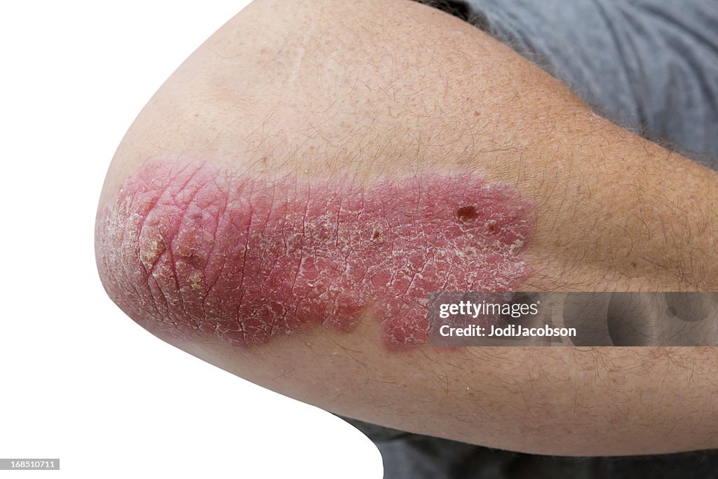 Psoriasis on a mid age mans  elbow